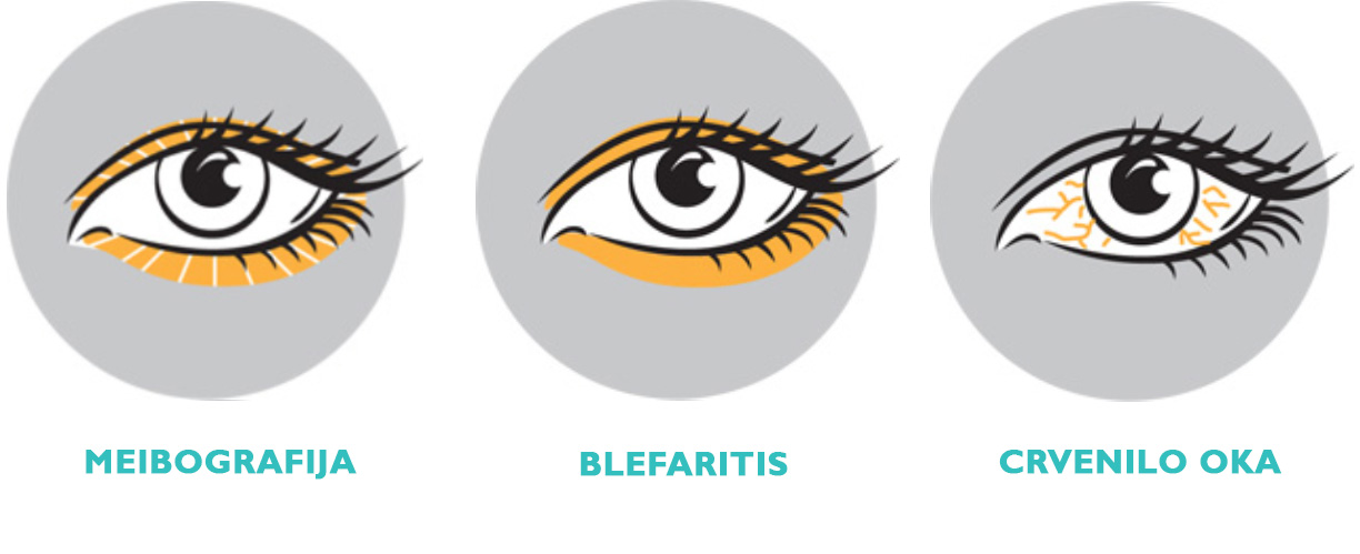 Meibografija - Blefaritis - Klasifikacija crvenila oka 