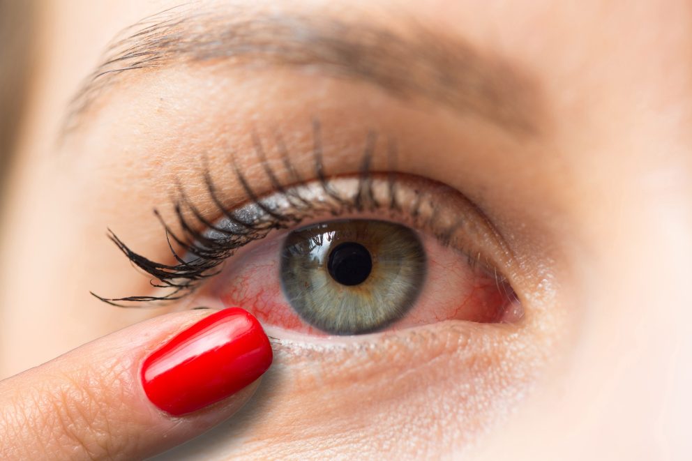 Žena pokazuje prstom na crveno upaljeno oko