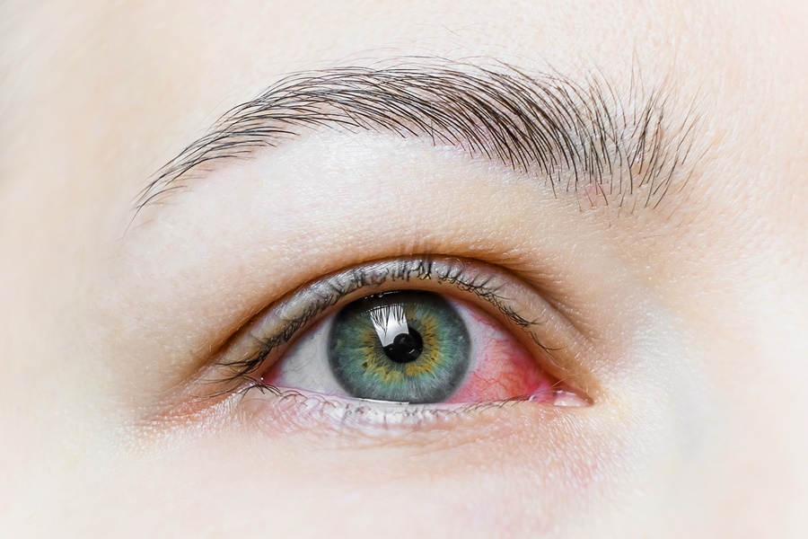 Crveno oko uzrokovano konjunktivitisom